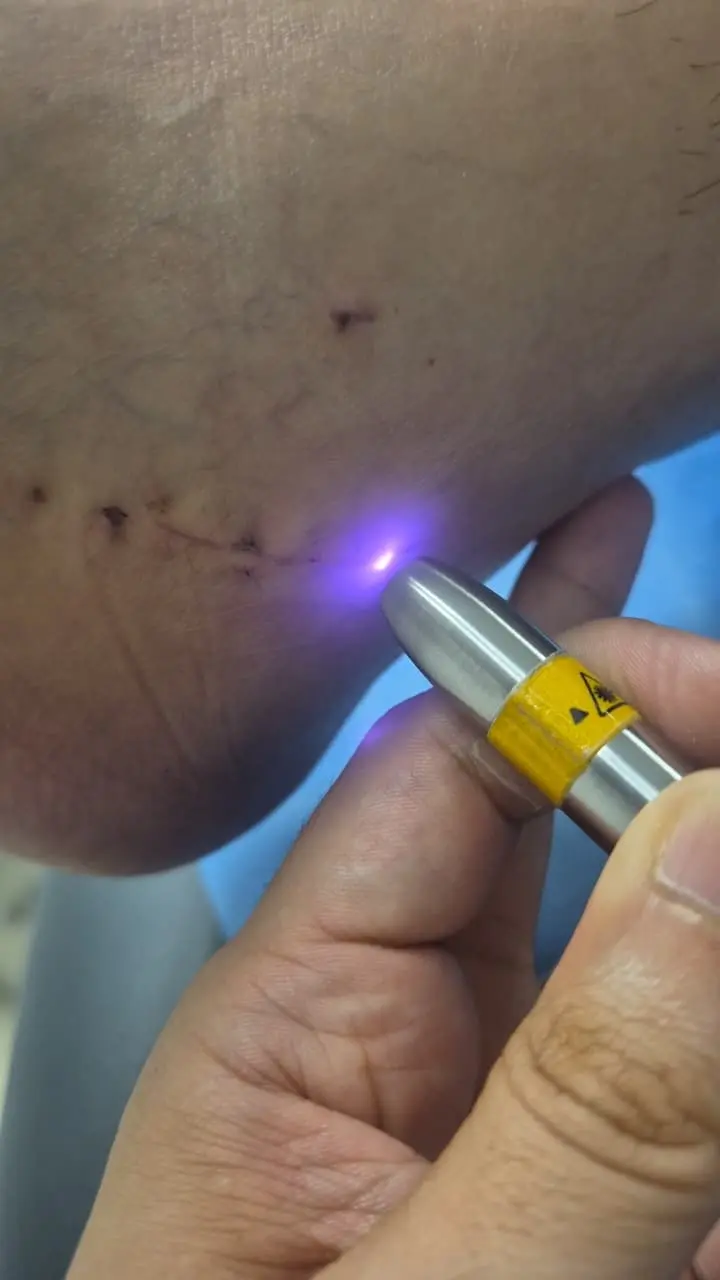 Laserterapia